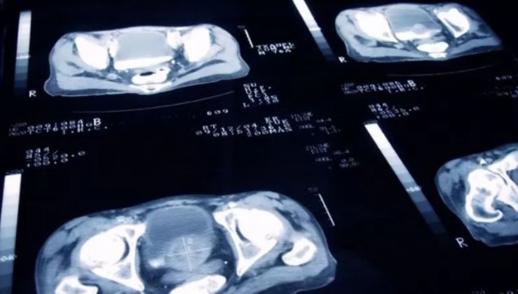Prostat kanseri: Yeni bir çalışma radyasyon tedavisi dozlarının önemli ölçüde azaltılabileceğini gösteriyor