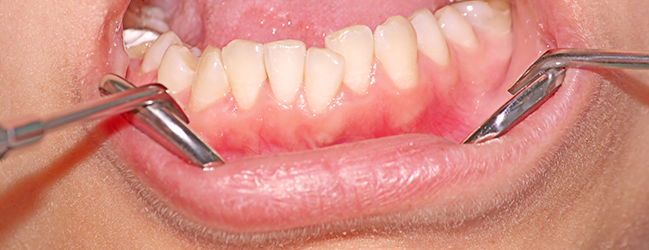 Diş Eti Hastalığı Nasıl Önlenir ve Nasıl Tedavi Edilir