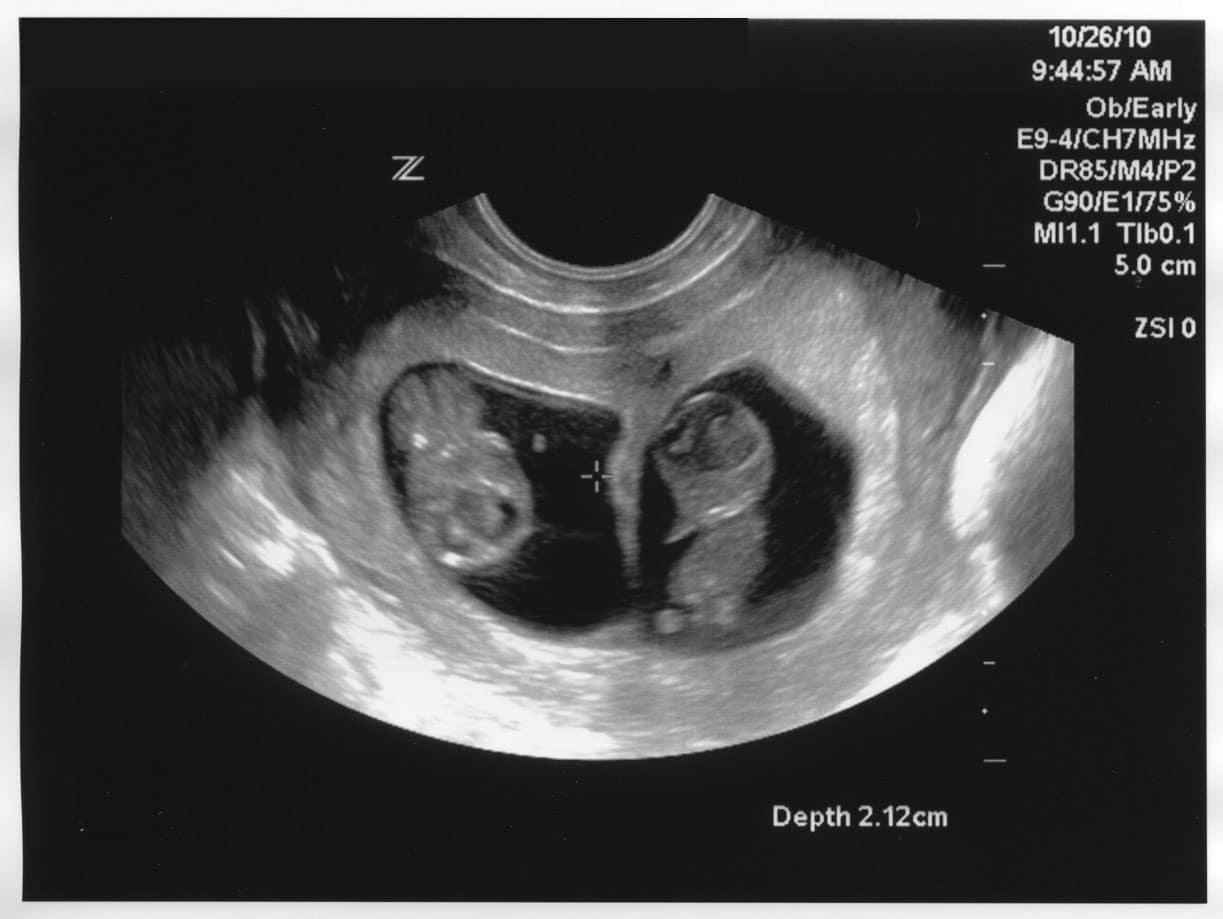 8 недель беременности вторая беременность. Многоплодная беременность на УЗИ 7 недель. УЗИ 10 недель беременности двойня. Фото УЗИ двойни на 10 неделе беременности. УЗИ плода на 9 акушерской неделе беременности.