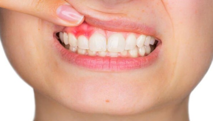 Diş ve diş eti bakımı nasıl yapılmalıdır?