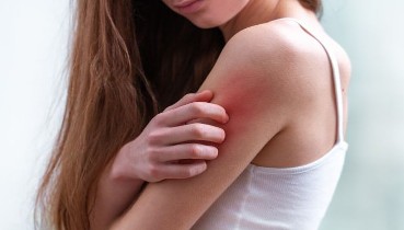 Tratamientos para la psoriasis