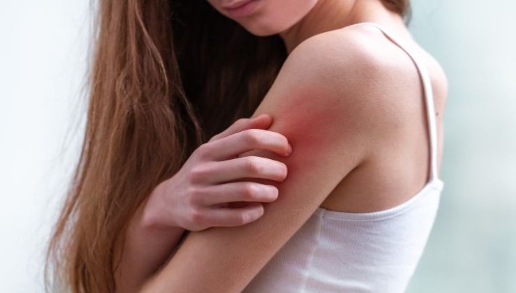 Tratamientos para la psoriasis