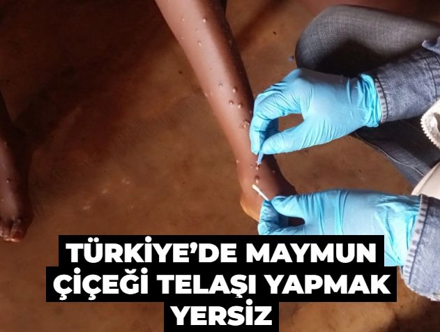 Türkiye’de maymun çiçeği telaşı yapmak yersiz