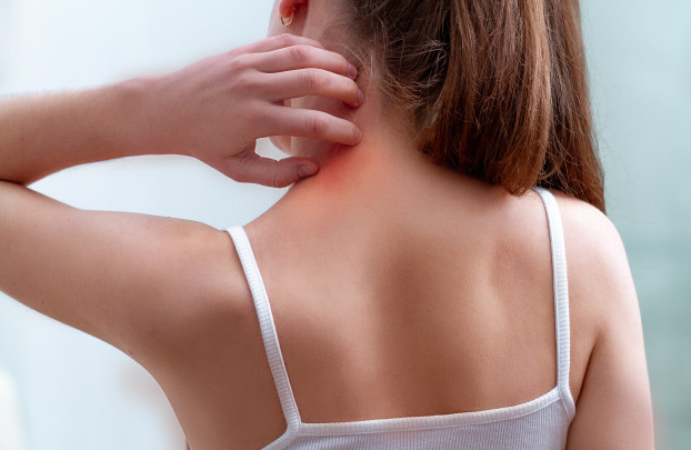 علاج الصدفية