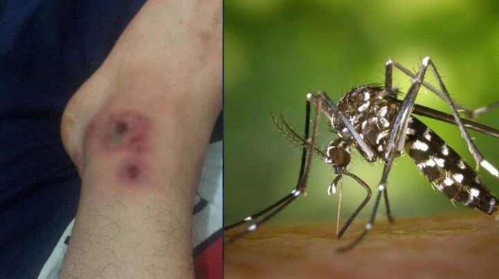 İstanbul'da "Asya Kaplanı" Sivrisineği Alarmı! Isırığındaki Virüsler Kana Karışırsa...