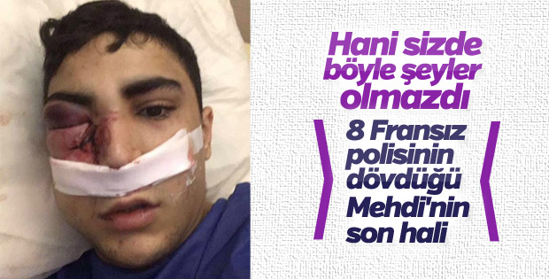 8 polisin saldırdığı genç bir gözünü kaybetti
