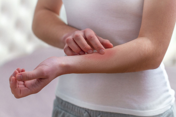 Tratamientos para la psoriasis