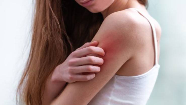 Tratamientos para la psoriasis