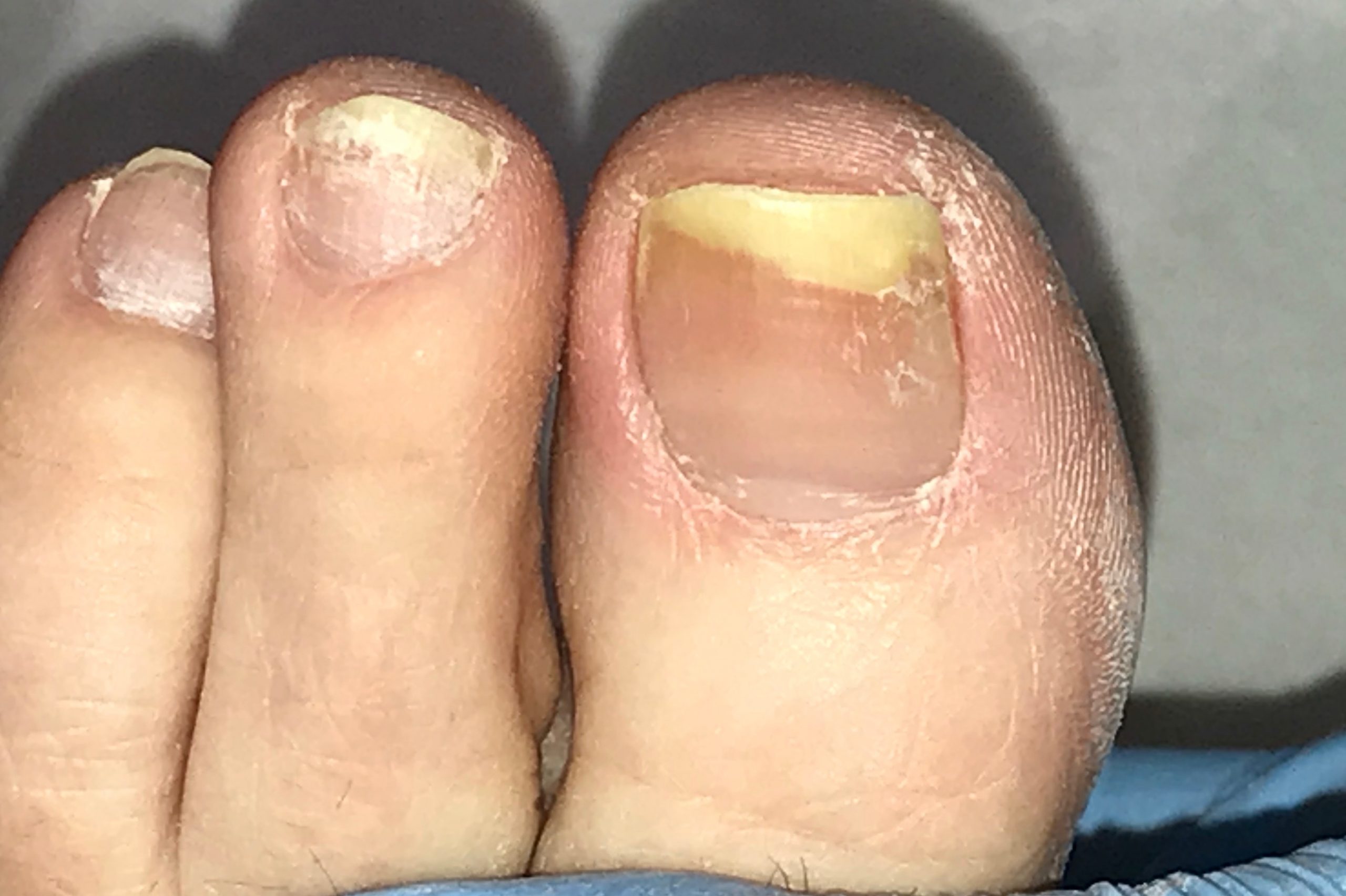 Try One of These 10 Home Remedies for Toenail Fungus