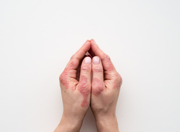 علاج الصدفية