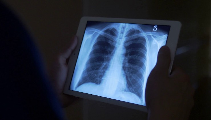 Kadınlarda akciğer kanserinden ölümlerde artış görülebilir