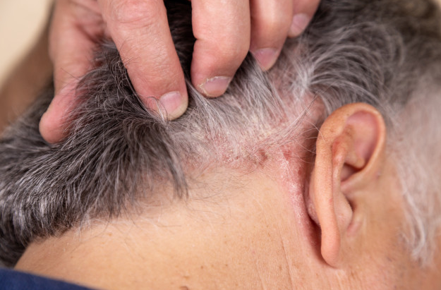 Psoriasis Treatments