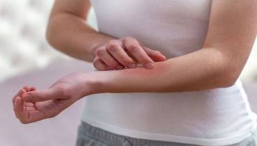 Psoriasis Treatments