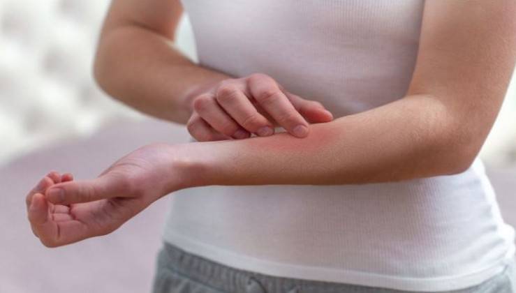 Psoriasis Treatments