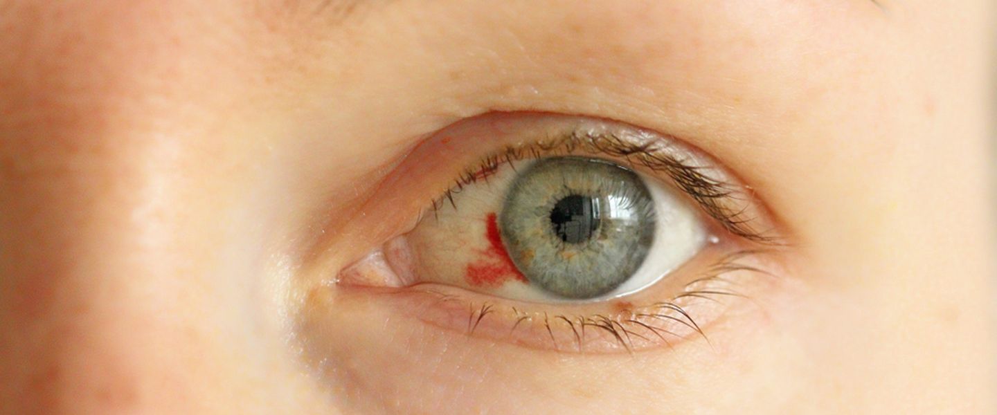 Göz kanlanması ve tedavi yöntemleri